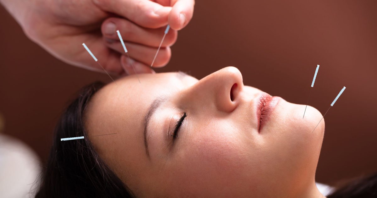 Woman Receiving Acupuncture Treatment On Her Face Acupuncture Treatment