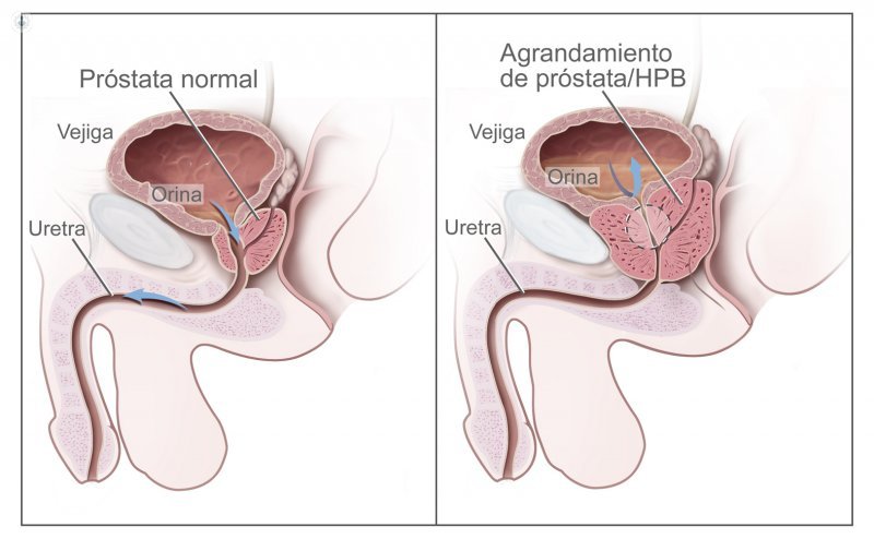 Prostata norma y prostata agrandada Centro de acupuntura Dra. Lu en Barcelona