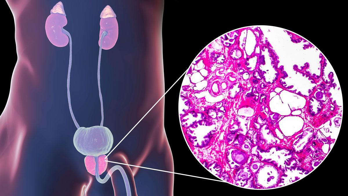 Ilustración anatómica de prostata agrandada e imagen en microscopio del proceso de crecimiento del tejido prostático