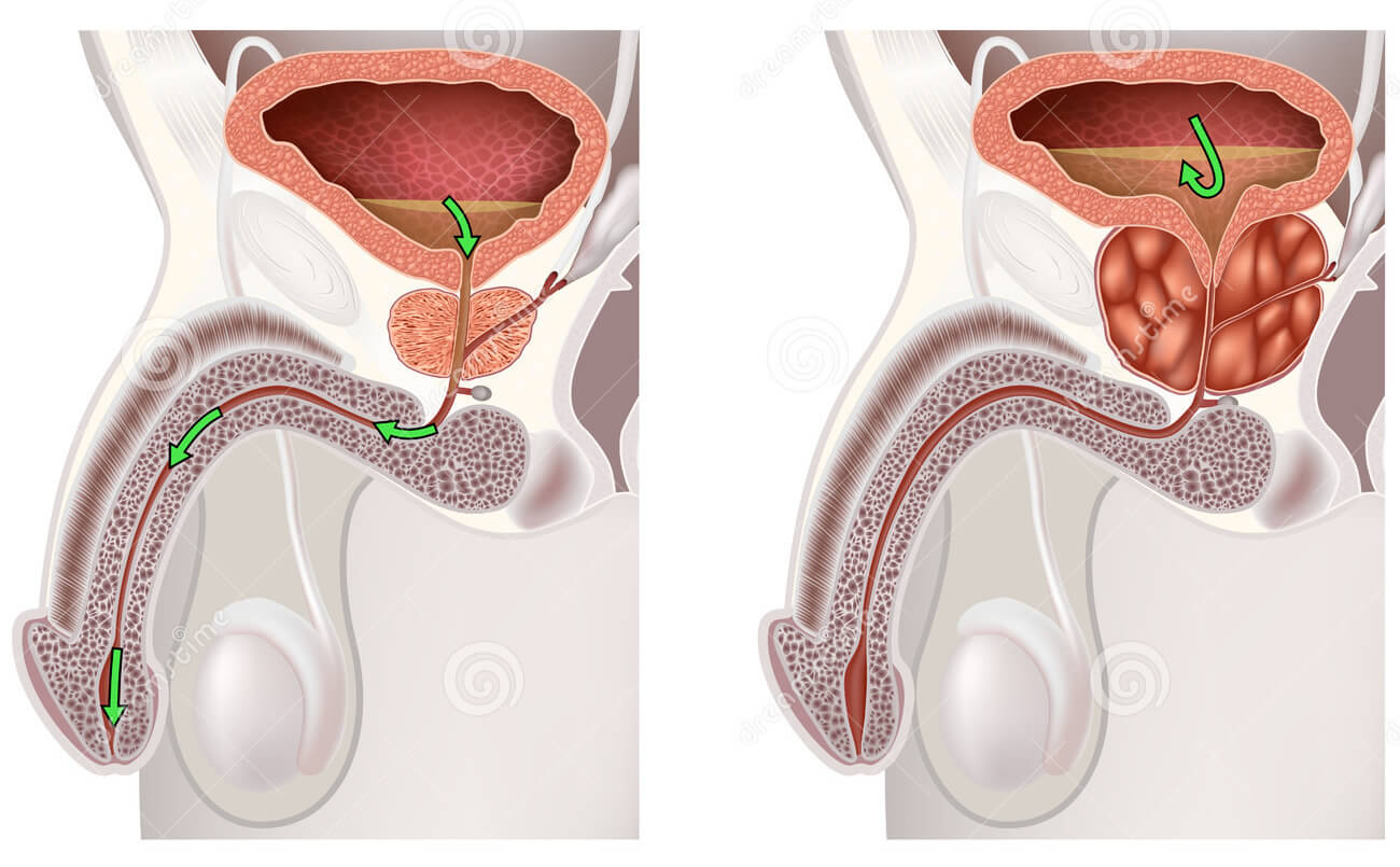 Ilustración del efecto de compresión de una prostata agrandada sobre espesor conducto de la uretra